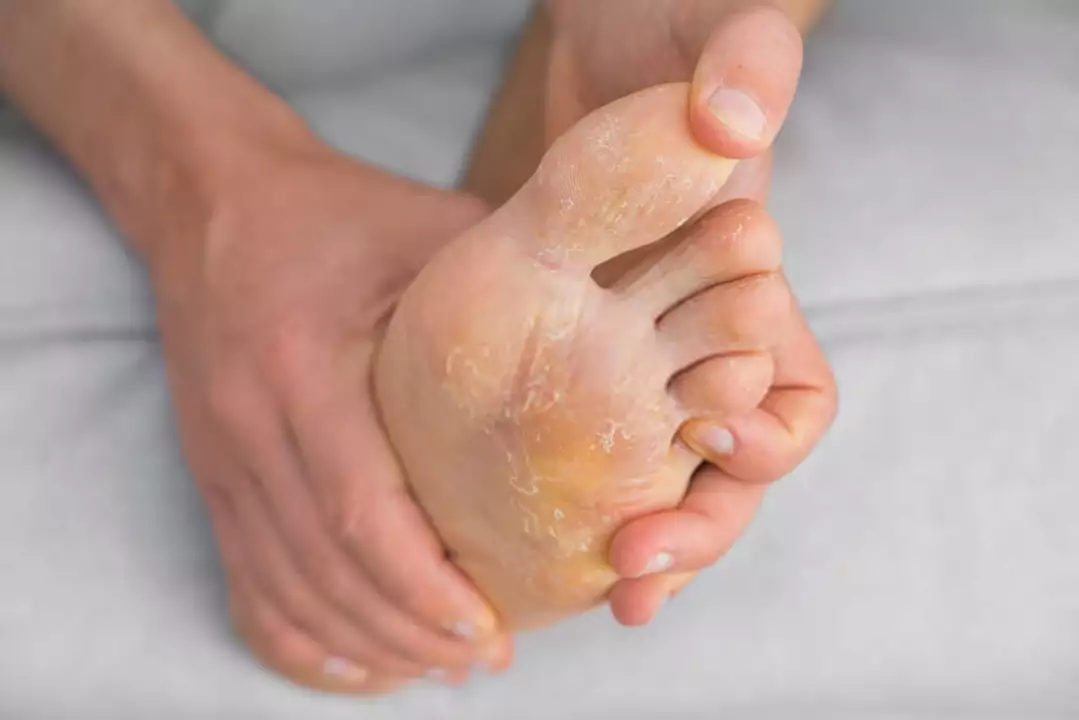 Desonide for Athlete's Foot: A Viable Treatment Option?