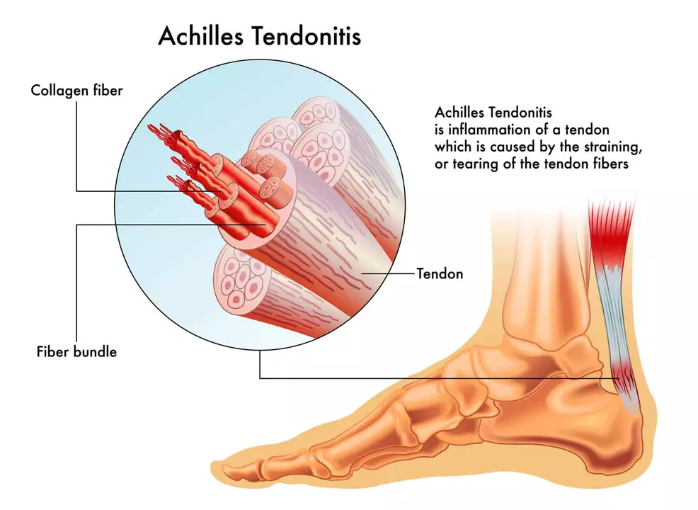 Tendonitis vs. Tendinosis: What's the Difference?