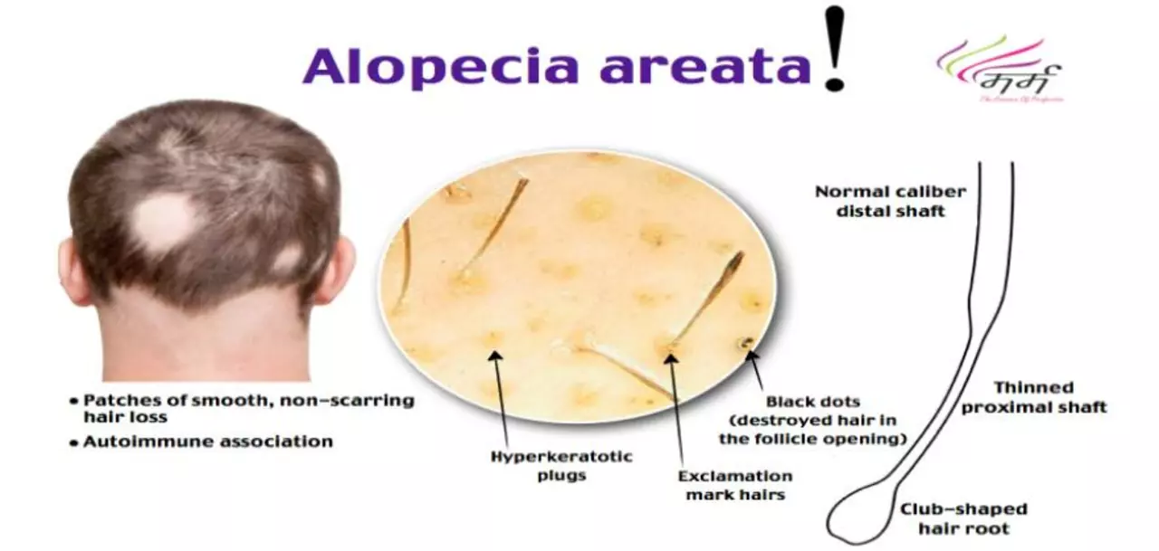 The use of betamethasone in the treatment of alopecia areata